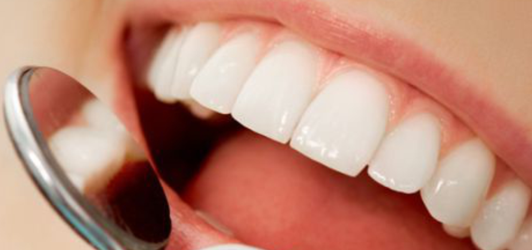 Saúde Bucal: A diferença entre placa bacteriana e tártaro nos dentes